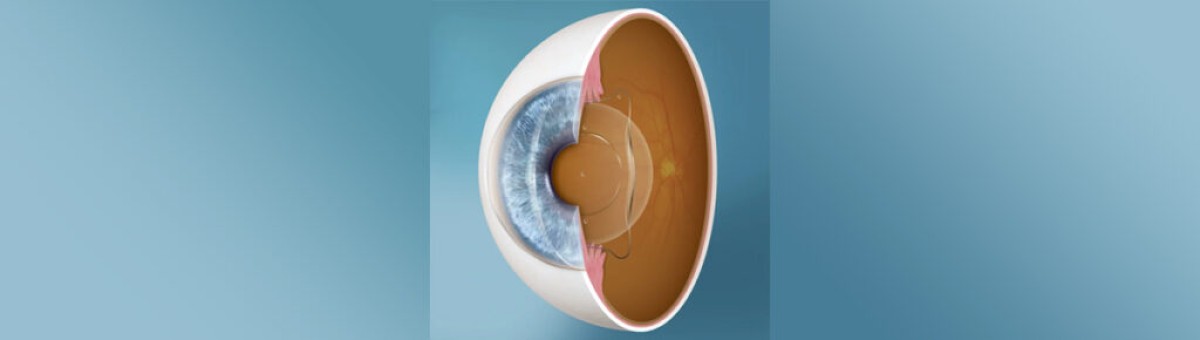 Chirurgie avec implants et de la cataracte