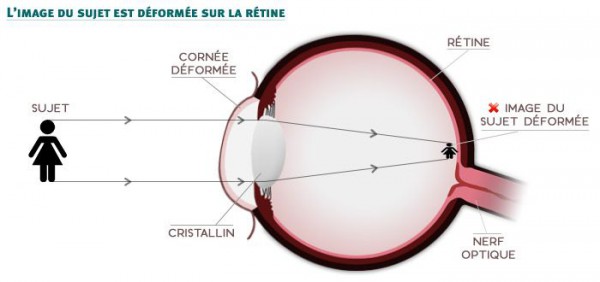 Schéma de l’œil astigmate