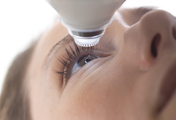 Chirurgie laser : avec le LASIK