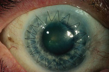 Greffe de cornée (kératoplastie)