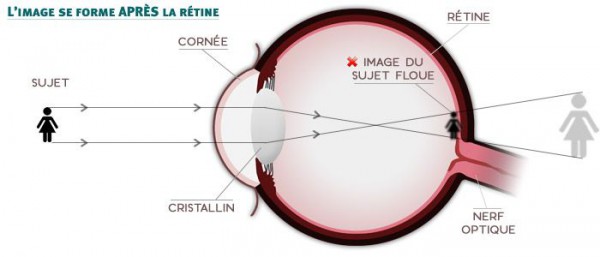 Schéma de l’œil hypermétrope