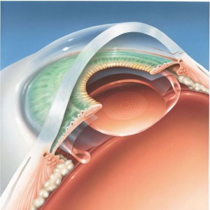 Implant oculaire