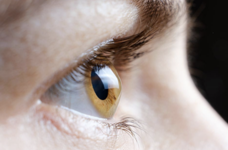 Kératocône - Excroissance malformative de la cornée