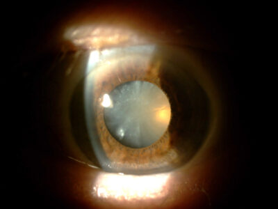 Exemple d'un oeil atteint de cataracte