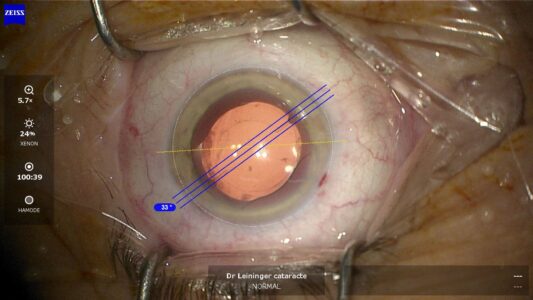 Pose d'un implant Toric lors d'une intervention de chirurgie de la cataracte