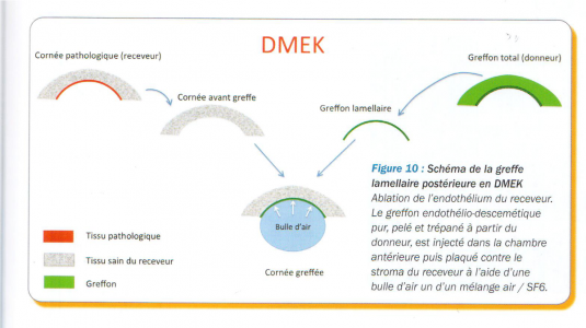 Schéma de la greffe de cornée endothéliale pure (DMEK)