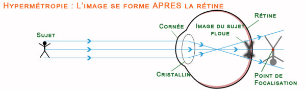 Schéma de la vision chez un astigmate