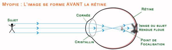 Schéma de la vision chez un myope